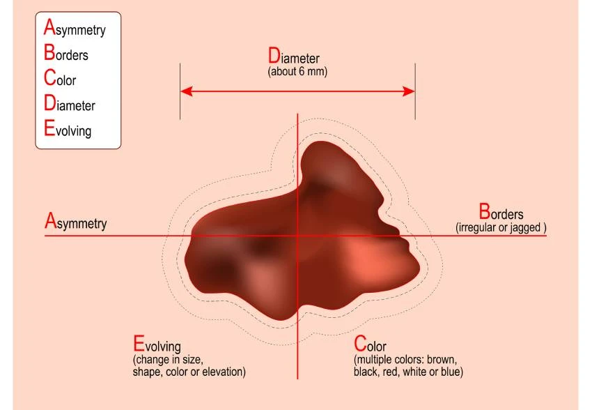 ABCDE melanoma